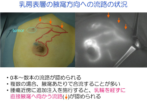 乳房表層の腋窩方向への流路の状況