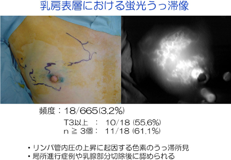 乳房表層における蛍光うっ滞像