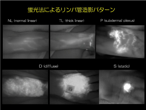 蛍光法によるリンパ管造影パターン